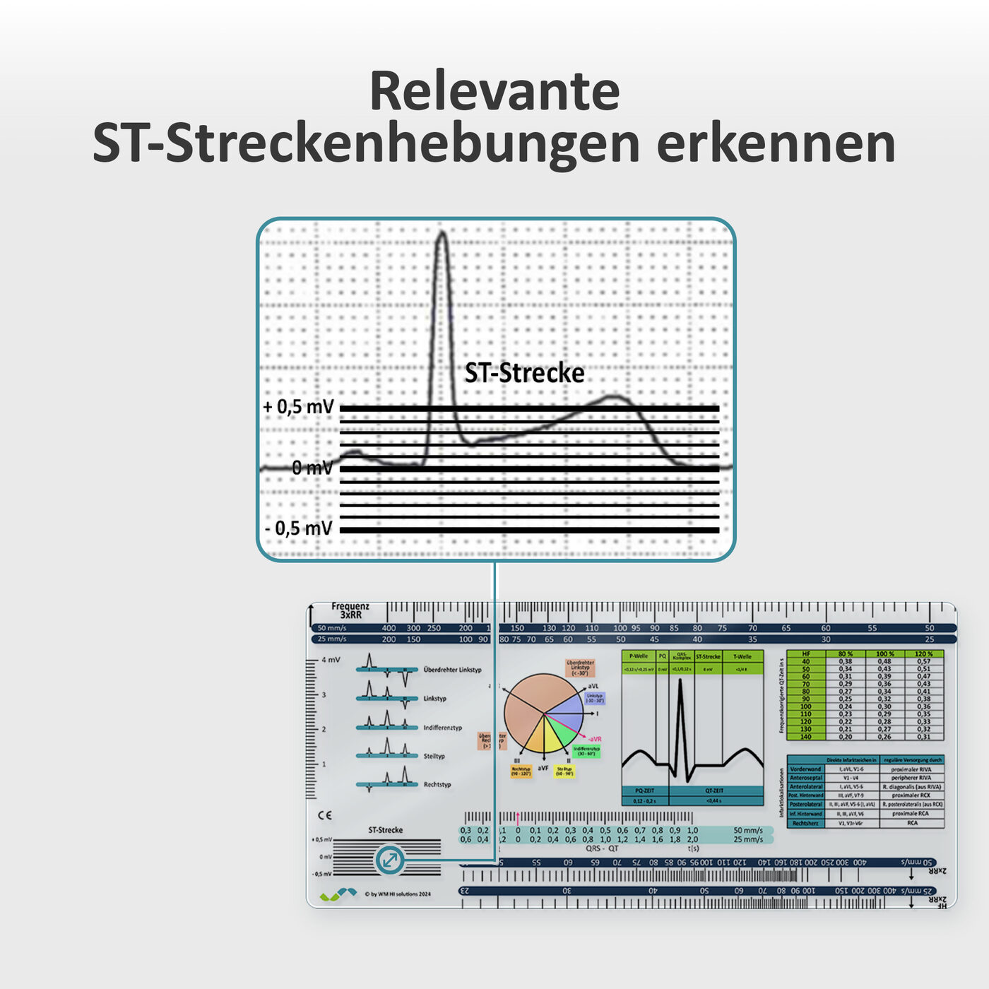 EKG-Lineal V1: Relevante ST-Streckenhebungen erkennen