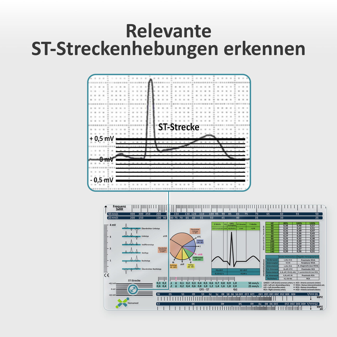 EKG-Lineal V2: Relevante ST-Streckenhebungen erkennen
